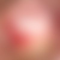 AIN. Anale Dysplasie. Großes, hyperkeratotisches Areal mit kleineren Satelliten-Läsionen. Die Obe...