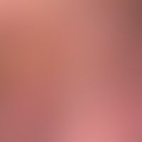 Enlargement of the irregular (in places reticular) pigmentation of the neck of a 40-year-old pati...