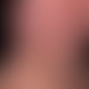 Dirty neck. Flächenhafte, unscharf begrenzte, unregelmäßige (stellenweise netzartig) Pigmentierun...