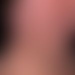 Dirty neck. Flächenhafte, unscharf begrenzte, unregelmäßige (stellenweise netzartig) Pigmentierun...