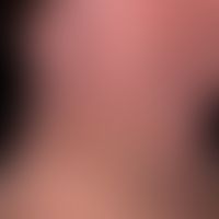Dirty neck. extensive, blurred, irregular (in places reticulated) pigmentation on the neck of a 4...
