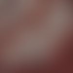 Aspergillus fumigatus: Aspergillosis of the kidney caused by A. fumigatus; smooth-walled, septate...