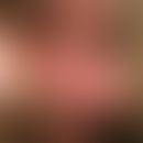 PIN. Im Bereich der Gans penis zeigen sich bei einem 42jährigen Patienten multiple, erythematöse,...