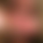 PIN. Im Bereich der Gans penis zeigen sich bei einem 42jährigen Patienten multiple, erythematöse,...