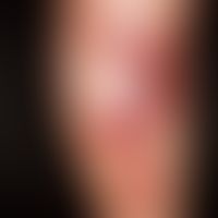 Primary cutaneous diffuse large-cell B-cell lymphoma leg type: nodules and plaques on the lower l...