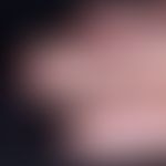 Hamartom, ekkrines, angiomatöses. Befund bei einem 12-jährigen Jungen. Seit dem 1. Lebensjahr lan...