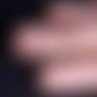 Hamartom, ekkrines, angiomatöses. Befund bei einem 12-jährigen Jungen. Seit dem 1. Lebensjahr lan...