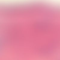 hemangioma, microvenous. blurred nest- and strand-like tumour formations penetrating the middle d...