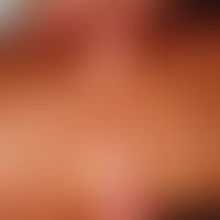 Fibrosis, nephrogenic systemic. large-area, board-hard induration of the skin with reduced mobili...