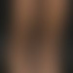 Fibrosis, nephrogenic systemic. chronic persistent, large-area, brownish hyperpigmented, board-ha...