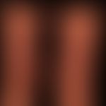 Fibrosis, nephrogenic systemic. large-area, board-hard induration of the hyperpigmented skin with...