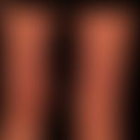Fibrosis, nephrogenic systemic. large-area, board-hard induration of the hyperpigmented skin with...