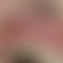 Neutropenia. cyclic neutropenia. solitary, chronic recurrent ulcer, persisting for 4 weeks, very ...