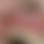 Neutropenia. cyclic neutropenia. solitary, chronic recurrent ulcer, persisting for 4 weeks, very ...