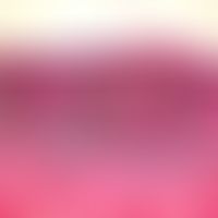 Melanom, malignes, animal-type. Diffuse Ansammlung dichter Melanophagenrasen in der oberen und mi...