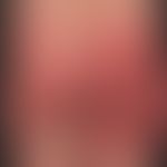 SDRIFE: großflächige, akute urtikarielle Plaques mit unscharfer Berandung.&nbsp;Mit einer gewisse...