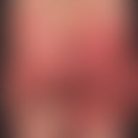 SDRIFE: large, acute urticarial plaques with blurred edges, with a certain probability caused by ...