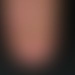 Psoriasis of the nails. approx. 4 x 5 mm oil stain on the distal nail matrix near the inflamed na...