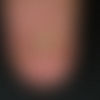 Psoriasis of the nails. approx. 4 x 5 mm oil stain on the distal nail matrix near the inflamed na...