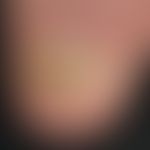 Psoriasis of the nails: psoriatic onychodystrophy in a 51-year-old patient with psoriasis vulgari...