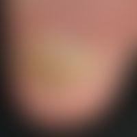 Psoriasis of the nails: psoriatic onychodystrophy in a 51-year-old patient with psoriasis vulgari...