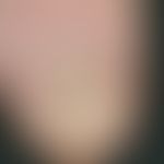 psoriasis of the nails. severe onychodystrophy with wave-like transverse ligament with simultaneo...