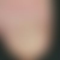 psoriasis of the nails. severe onychodystrophy with wave-like transverse ligament with simultaneo...