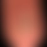 psoriasis of the nails. subungualand ungual changes. the changes in the nail plate correspond to ...