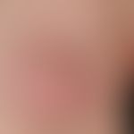 Interstitial granulomatous dermatitis with plaques. 10 months ago, erythematous plaques, initiall...