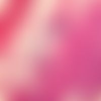 Calciphylaxis, cutaneous diffuse calcinosis of the lipocytes and the connective tissue septum of ...