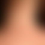 Virusexantheme (Mononukleose):Disseminierte Flecken an Hals und Nacken einer 16-jährigen Patienti...