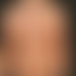 Virusexantheme. Übersichtsaufnahme: Disseminierte Flecken an Stamm, Decolleté und Brust einer 16-...