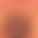 SCID:&nbsp;Verrucosis generalisata. Multiple Viruswarzen an Unterbauch, Oberschenkel und&nbsp;&nb...