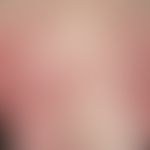 Arzneimittelexanthem, makulo-papulöses. Multiple, akute, seit 4 Tagen bestehende, generalisierte,...