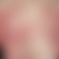 Arzneimittelexanthem, makulo-papulöses. Multiple, akute, seit 4 Tagen bestehende, generalisierte,...