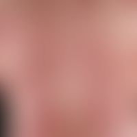 Drug exanthema, maculo-papular. multiple, acute, since 3 days generalized, disseminated, dense, b...