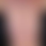 Arzneimittelexanthem, makulo-papulöses. Multiple, akut aufgetretene, generalisierte, stark jucken...