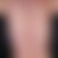 Drug exanthema, maculo-papular multiple, acutely occurring, generalized, strongly itching, mainly...