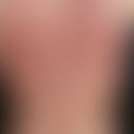 Arzneimittelexanthem, makulo-papulöses. Multiple, akut aufgetretene, generalisierte, stark jucken...