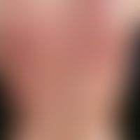 Drug exanthema, maculo-papular. multiple, acutely occurring, generalized, very itchy, mainly on t...