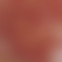 Incidentlight microscopy, angiectatic basic pattern Incident light microscopy: Angiectatic basic ...