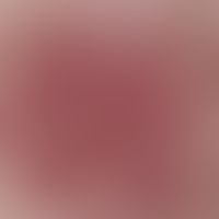 Incidentlight microscopy, angiectatic basic pattern. incident light microscopy: Angiectatic basic...