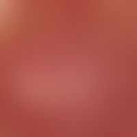 Reflected light microscopy: Area ofuniformly arranged puncttiform or polymorphic capillaries Refl...