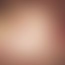 Immundefekt, variabler, primärer. Nekrotisierende Wundheilungsstörung nach Varizelleninfektion be...