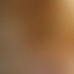 Auflichtmikroskopie, intraläsionale Gefäßaneurysmen und Blutseen. Auflichtmikroskopie (Ausschnitt...