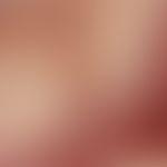 Auflichtmikroskopie, intraläsionale Gefäßaneurysmen und Blutseen. Auflichtmikroskopie (Ausschnitt...