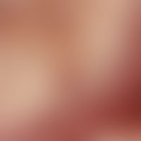 Auflichtmikroskopie, intraläsionale Gefäßaneurysmen und Blutseen. Auflichtmikroskopie (Ausschnitt...