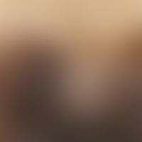 Auflichtmikroskopie, sakkuläres Muster. Auflichtmikroskopie (Ausschnitt): Grau-bläuliches sakkulä...