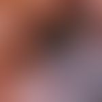 Auflichtmikroskopie, bläulich-/weißlich-opake Schleier. Auflichtmikroskopie (Ausschnitt: SSM, Cla...