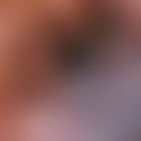Auflichtmikroskopie, bläulich-/weißlich-opake Schleier. Auflichtmikroskopie (Ausschnitt: SSM, Cla...
